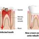 عفونت ریشه دندان و درمان آن